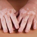 Menkes: Vitiligo Bukan Penyakit Memalukan