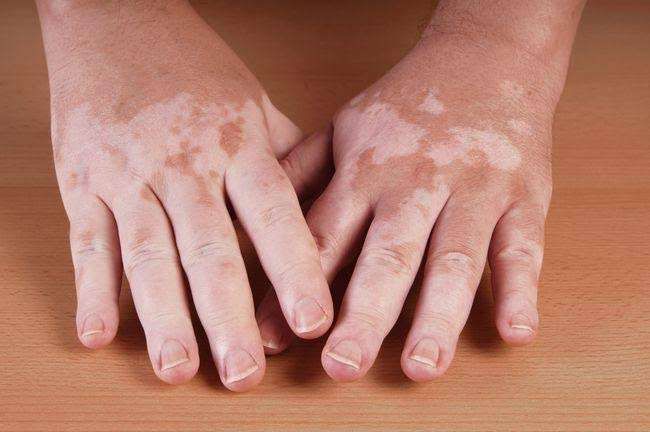 Menkes: Vitiligo Bukan Penyakit Memalukan